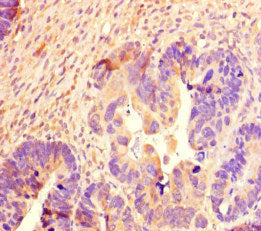 Immunohistochemistry of paraffin-embedded human ovarian cancer using SCG2 Antibody at dilution of 1:100Rabbit anti-Human SCG2 Polyclonal Antibody