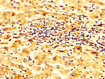 IHC image of SCNN1B Antibody diluted at 1:300 and staining in paraffin-embedded human liver cancer performed on a Leica BondTM system. After dewaxing and hydration, antigen retrieval was mediated by high pressure in a citrate buffer (pH 6.0). Section was blocked with 10% normal goat serum 30min at RT. Then primary antibody (1% BSA) was incubated at 4°C overnight. The primary is detected by a biotinylated secondary antibody and visualized using an HRP conjugated SP system.Rabbit anti-Human SCNN1B Polyclonal Antibody