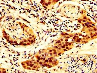 IHC image of SCNN1B Antibody diluted at 1:300 and staining in paraffin-embedded human bladder cancer performed on a Leica BondTM system. After dewaxing and hydration, antigen retrieval was mediated by high pressure in a citrate buffer (pH 6.0). Section was blocked with 10% normal goat serum 30min at RT. Then primary antibody (1% BSA) was incubated at 4°C overnight. The primary is detected by a biotinylated secondary antibody and visualized using an HRP conjugated SP system.Rabbit anti-Human SCNN1B Polyclonal Antibody