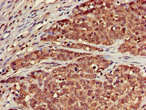 Immunohistochemistry of paraffin-embedded human ovarian cancer using SCTR Antibody at dilution of 1:100Rabbit anti-Human SCTR Polyclonal Antibody