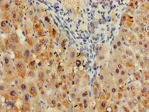 Immunohistochemistry of paraffin-embedded human liver tissue using the antibody at dilution of 1:100Rabbit anti-Human SDCBP Polyclonal Antibody