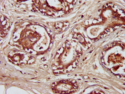 IHC image of ENTR1 Antibody diluted at 1:300 and staining in paraffin-embedded human breast cancer performed on a Leica BondTM system. After dewaxing and hydration, antigen retrieval was mediated by high pressure in a citrate buffer (pH 6.0). Section was blocked with 10% normal goat serum 30min at RT. Then primary antibody (1% BSA) was incubated at 4°C overnight. The primary is detected by a biotinylated secondary antibody and visualized using an HRP conjugated SP system.Rabbit anti-Human ENTR1 Polyclonal Antibody