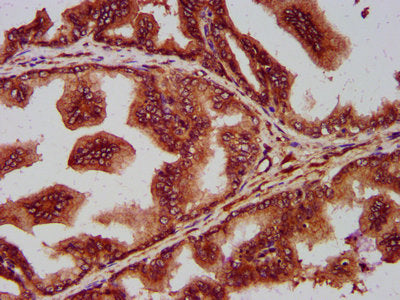 IHC image of SEC14L2 Antibody diluted at 1:400 and staining in paraffin-embedded human prostate tissue performed on a Leica BondTM system. After dewaxing and hydration, antigen retrieval was mediated by high pressure in a citrate buffer (pH 6.0). Section was blocked with 10% normal goat serum 30min at RT. Then primary antibody (1% BSA) was incubated at 4°C overnight. The primary is detected by a biotinylated secondary antibody and visualized using an HRP conjugated SP system.Rabbit anti-Human SEC14L2 Polyclonal Antibody