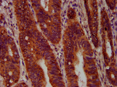 IHC image of SEC14L2 Antibody diluted at 1:400 and staining in paraffin-embedded human colon cancer performed on a Leica BondTM system. After dewaxing and hydration, antigen retrieval was mediated by high pressure in a citrate buffer (pH 6.0). Section was blocked with 10% normal goat serum 30min at RT. Then primary antibody (1% BSA) was incubated at 4°C overnight. The primary is detected by a biotinylated secondary antibody and visualized using an HRP conjugated SP system.Rabbit anti-Human SEC14L2 Polyclonal Antibody