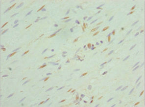 Immunohistochemistry of paraffin-embedded human colon cancer using SEPHS1 Antibody at dilution of 1:100Rabbit anti-Human SEPHS1 Polyclonal Antibody