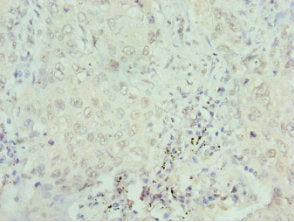 Immunohistochemistry of paraffin-embedded human lung cancer using SEPHS1 Antibody at dilution of 1:100Rabbit anti-Human SEPHS1 Polyclonal Antibody