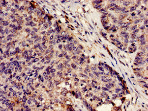 Immunohistochemistry analysis of human ovarian cancer using SERPINA5 Antibody at dilution of 1:100Rabbit anti-Human SERPINA5 Polyclonal Antibody