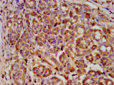 IHC image of the antibody diluted at 1:600 and staining in paraffin-embedded human pancreatic cancer performed on a Leica BondTM system. After dewaxing and hydration, antigen retrieval was mediated by high pressure in a citrate buffer (pH 6.0). Section was blocked with 10% normal goat serum 30min at RT. Then primary antibody (1% BSA) was incubated at 4°C overnight. The primary is detected by a biotinylated secondary antibody and visualized using an HRP conjugated SP system.Rabbit anti-Human SERPINB4 Polyclonal Antibody