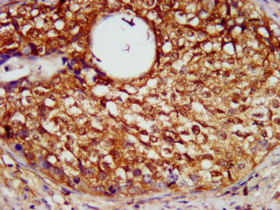 IHC image of SERPINB4 Antibody diluted at 1:600 and staining in paraffin-embedded human cervical cancer performed on a Leica BondTM system. After dewaxing and hydration, antigen retrieval was mediated by high pressure in a citrate buffer (pH 6.0). Section was blocked with 10% normal goat serum 30min at RT. Then primary antibody (1% BSA) was incubated at 4°C overnight. The primary is detected by a biotinylated secondary antibody and visualized using an HRP conjugated SP system.Rabbit anti-Human SERPINB4 Polyclonal Antibody