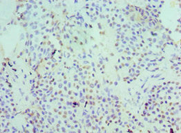 Immunohistochemistry of paraffin-embedded human breast cancer using SERPINB5 Antibody at dilution of 1:100Rabbit anti-Human SERPINB5 Polyclonal Antibody