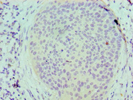 Immunohistochemistry of paraffin-embedded human cervical cancer using SERPINB5 Antibody at dilution of 1:100Rabbit anti-Human SERPINB5 Polyclonal Antibody