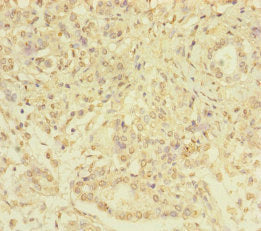 Immunohistochemistry of paraffin-embedded human pancreatic cancer using SERPINB6 Antibody at dilution of 1:100Rabbit anti-Human SERPINB6 Polyclonal Antibody