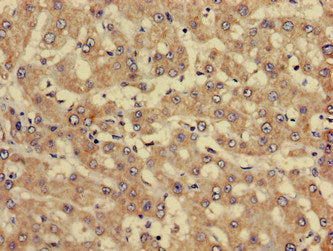 Immunohistochemistry of paraffin-embedded human liver cancer using SERPINC1 Antibody at dilution of 1:100Rabbit anti-Human SERPINC1 Polyclonal Antibody