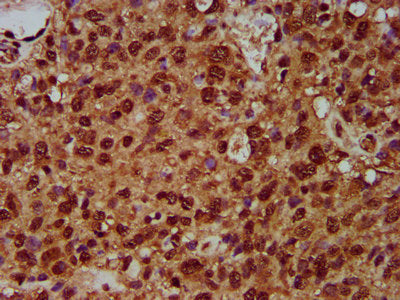 IHC image of SF3B1 Antibody diluted at 1:200 and staining in paraffin-embedded human glioma performed on a Leica BondTM system. After dewaxing and hydration, antigen retrieval was mediated by high pressure in a citrate buffer (pH 6.0). Section was blocked with 10% normal goat serum 30min at RT. Then primary antibody (1% BSA) was incubated at 4°C overnight. The primary is detected by a biotinylated secondary antibody and visualized using an HRP conjugated SP system.Rabbit anti-Human SF3B1 Polyclonal Antibody