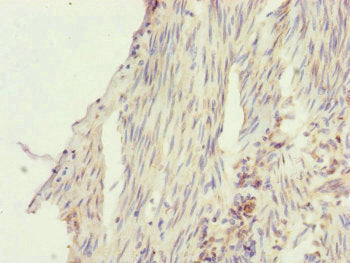 Immunohistochemistry of paraffin-embedded human bladder cancer using SFI1 Antibody at dilution of 1:100