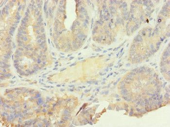 Immunohistochemistry of paraffin-embedded human endometrial cancer using SFI1 Antibody at dilution of 1:100
