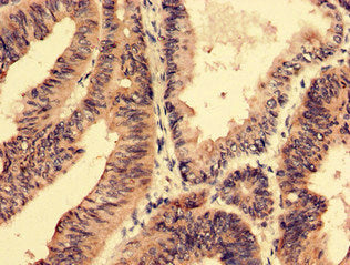 Immunohistochemistry analysis of human colon cancer using SFRP4 Antibody at dilution of 1:100Rabbit anti-Human SFRP4 Polyclonal Antibody