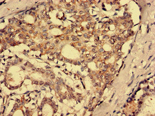 Immunohistochemistry analysis of human breast cancer using SFRP4 Antibody at dilution of 1:100Rabbit anti-Human SFRP4 Polyclonal Antibody