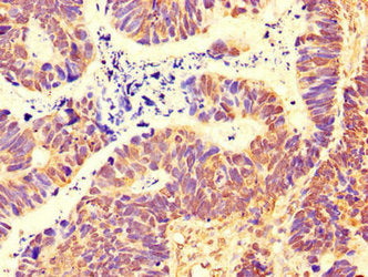 Immunohistochemistry of paraffin-embedded human ovarian cancer using SH3BP5 Antibody at dilution of 1:100Rabbit anti-Human SH3BP5 Polyclonal Antibody