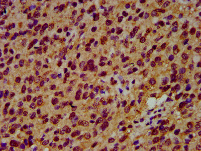 IHC image of the antibody diluted at 1:600 and staining in paraffin-embedded human glioma performed on a Leica BondTM system. After dewaxing and hydration, antigen retrieval was mediated by high pressure in a citrate buffer (pH 6.0). Section was blocked with 10% normal goat serum 30min at RT. Then primary antibody (1% BSA) was incubated at 4°C overnight. The primary is detected by a biotinylated secondary antibody and visualized using an HRP conjugated SP system.Rabbit anti-Human SIAH2 Polyclonal Antibody