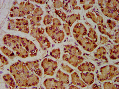 IHC image of SIAH2 Antibody diluted at 1:600 and staining in paraffin-embedded human pancreatic cancer performed on a Leica BondTM system. After dewaxing and hydration, antigen retrieval was mediated by high pressure in a citrate buffer (pH 6.0). Section was blocked with 10% normal goat serum 30min at RT. Then primary antibody (1% BSA) was incubated at 4°C overnight. The primary is detected by a biotinylated secondary antibody and visualized using an HRP conjugated SP system.Rabbit anti-Human SIAH2 Polyclonal Antibody