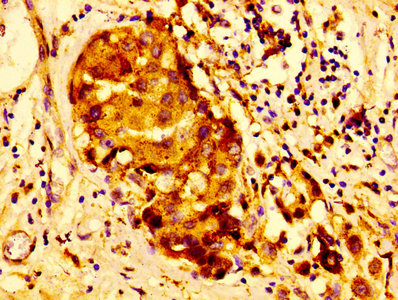 Immunohistochemistry of paraffin-embedded human breast cancer using CTSD Antibody at dilution of 1:100Rabbit anti-Human CTSD Polyclonal Antibody