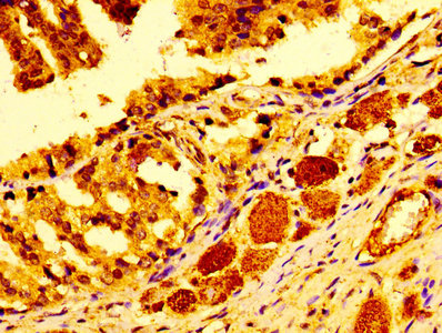 Immunohistochemistry of paraffin-embedded human prostate cancer using CTSD Antibody at dilution of 1:100Rabbit anti-Human CTSD Polyclonal Antibody