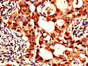 Immunohistochemistry of paraffin-embedded human lung cancer using the antibody at dilution of 1:100Rabbit anti-Human SIK1 Polyclonal Antibody