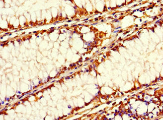 Immunohistochemistry of paraffin-embedded human colon cancer using SIRPB1 Antibody at dilution of 1:100Rabbit anti-Human SIRPB1 Polyclonal Antibody