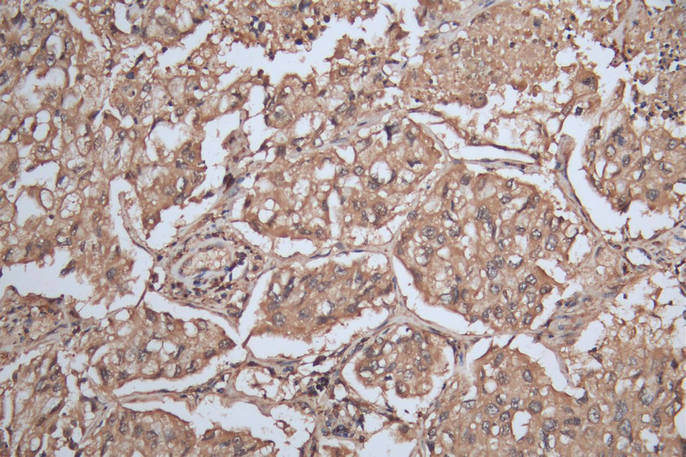 IHC image of the antibody diluted at 1:200 and staining in paraffin-embedded human lung cancer performed on a Leica BondTM system. After dewaxing and hydration, antigen retrieval was mediated by high pressure in a citrate buffer (pH 6.0). Section was blocked with 10% normal goat serum 30min at RT. Then primary antibody (1% BSA) was incubated at 4°C overnight. The primary is detected by a Goat anti-rabbit polymer IgG labeled by HRP and visualized using 0.05% DAB.Rabbit anti-Human SLAMF7 Polyclonal Antibody