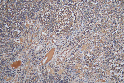 IHC image of SLAMF7 Antibody diluted at 1:200 and staining in paraffin-embedded human lymph node tissue performed on a Leica BondTM system. After dewaxing and hydration, antigen retrieval was mediated by high pressure in a citrate buffer (pH 6.0). Section was blocked with 10% normal goat serum 30min at RT. Then primary antibody (1% BSA) was incubated at 4°C overnight. The primary is detected by a Goat anti-rabbit polymer IgG labeled by HRP and visualized using 0.05% DAB.Rabbit anti-Human SLAMF7 Polyclonal Antibody