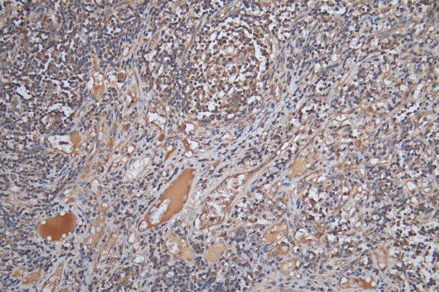 IHC image of SLAMF7 Antibody diluted at 1:200 and staining in paraffin-embedded human lymph node tissue performed on a Leica BondTM system. After dewaxing and hydration, antigen retrieval was mediated by high pressure in a citrate buffer (pH 6.0). Section was blocked with 10% normal goat serum 30min at RT. Then primary antibody (1% BSA) was incubated at 4°C overnight. The primary is detected by a Goat anti-rabbit polymer IgG labeled by HRP and visualized using 0.05% DAB.Rabbit anti-Human SLAMF7 Polyclonal Antibody
