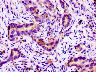 Immunohistochemistry of paraffin-embedded human pancreatic cancer using SLC11A2 Antibody at dilution of 1:100Rabbit anti-Human SLC11A2 Polyclonal Antibody