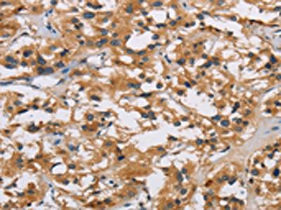 The image on the left is immunohistochemistry of paraffin-embedded Human thyroid cancer tissue using the antibody Antibody) at dilution 1/40, on the right is treated with synthetic peptide. (Original magnification: ×200)