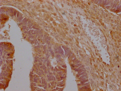 IHC image of SLC16A7 Antibody diluted at 1:200 and staining in paraffin-embedded human ovarian cancer performed on a Leica BondTM system. After dewaxing and hydration, antigen retrieval was mediated by high pressure in a citrate buffer (pH 6.0). Section was blocked with 10% normal goat serum 30min at RT. Then primary antibody (1% BSA) was incubated at 4°C overnight. The primary is detected by a Goat anti-rabbit polymer IgG labeled by HRP and visualized using 0.05% DAB.Rabbit anti-Human SLC16A7 Polyclonal Antibody