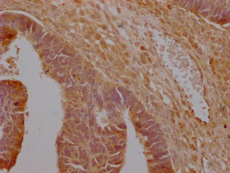 IHC image of SLC16A7 Antibody diluted at 1:200 and staining in paraffin-embedded human ovarian cancer performed on a Leica BondTM system. After dewaxing and hydration, antigen retrieval was mediated by high pressure in a citrate buffer (pH 6.0). Section was blocked with 10% normal goat serum 30min at RT. Then primary antibody (1% BSA) was incubated at 4°C overnight. The primary is detected by a Goat anti-rabbit polymer IgG labeled by HRP and visualized using 0.05% DAB.Rabbit anti-Human SLC16A7 Polyclonal Antibody