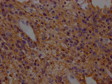 IHC image of the antibody diluted at 1:200 and staining in paraffin-embedded human glioma cancer performed on a Leica BondTM system. After dewaxing and hydration, antigen retrieval was mediated by high pressure in a citrate buffer (pH 6.0). Section was blocked with 10% normal goat serum 30min at RT. Then primary antibody (1% BSA) was incubated at 4°C overnight. The primary is detected by a Goat anti-rabbit polymer IgG labeled by HRP and visualized using 0.05% DAB.Rabbit anti-Human SLC1A3 Polyclonal Antibody