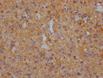 IHC image of the antibody diluted at 1:200 and staining in paraffin-embedded human glioma cancer performed on a Leica BondTM system. After dewaxing and hydration, antigen retrieval was mediated by high pressure in a citrate buffer (pH 6.0). Section was blocked with 10% normal goat serum 30min at RT. Then primary antibody (1% BSA) was incubated at 4°C overnight. The primary is detected by a Goat anti-rabbit polymer IgG labeled by HRP and visualized using 0.05% DAB.Rabbit anti-Human SLC1A3 Polyclonal Antibody