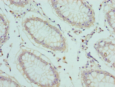 Immunohistochemistry of paraffin-embedded human colon cancer using SLC1A6 Antibody at dilution of 1:100Rabbit anti-Human SLC1A6 Polyclonal Antibody
