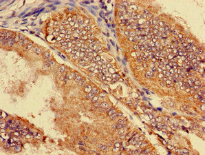 Immunohistochemistry of paraffin-embedded human endometrial cancer using SLC22A2 Antibody at dilution of 1:100Rabbit anti-Human SLC22A2 Polyclonal Antibody