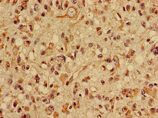 Immunohistochemistry of paraffin-embedded human glioma using SLC22A2 Antibody at dilution of 1:100Rabbit anti-Human SLC22A2 Polyclonal Antibody