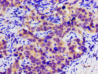Immunohistochemistry of paraffin-embedded human pancreatic cancer using SLC25A12 Antibody at dilution of 1:100Rabbit anti-Human SLC25A12 Polyclonal Antibody