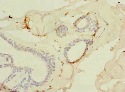 Immunohistochemistry of paraffin-embedded human breast cancer using SLC25A4 Antibody at dilution of 1:100Rabbit anti-Human SLC25A4 Polyclonal Antibody