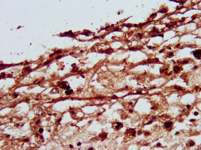 IHC image of SLC26A4 Antibody diluted at 1:500 and staining in paraffin-embedded human melanoma performed on a Leica BondTM system. After dewaxing and hydration, antigen retrieval was mediated by high pressure in a citrate buffer (pH 6.0). Section was blocked with 10% normal goat serum 30min at RT. Then primary antibody (1% BSA) was incubated at 4°C overnight. The primary is detected by a biotinylated secondary antibody and visualized using an HRP conjugated SP system.Rabbit anti-Human SLC26A4 Polyclonal Antibody