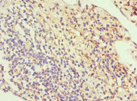 Immunohistochemistry of paraffin-embedded human cervical cancer using SLC2A1 Antibody at dilution of 1:100Rabbit anti-Human SLC2A1 Polyclonal Antibody