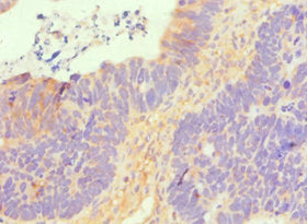 Immunohistochemistry of paraffin-embedded human ovarian cancer using SLC2A1 Antibody at dilution of 1:100Rabbit anti-Human SLC2A1 Polyclonal Antibody