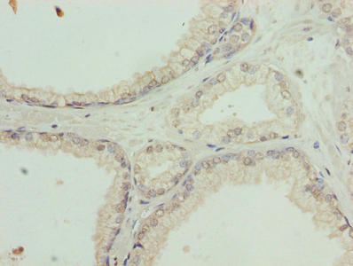 Immunohistochemistry of paraffin-embedded human prostate cancer using the antibody at dilution of 1:100Rabbit anti-Human SLC31A2 Polyclonal Antibody