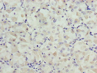 Immunohistochemistry of paraffin-embedded human gastric cancer using SLC31A2 Antibody at dilution of 1:100Rabbit anti-Human SLC31A2 Polyclonal Antibody