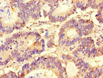 Immunohistochemistry of paraffin-embedded human colon cancer using the antibody at dilution of 1:100Rabbit anti-Human SLC37A1 Polyclonal Antibody