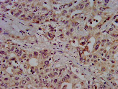 IHC image of the antibody diluted at 1:500 and staining in paraffin-embedded human liver cancer performed on a Leica BondTM system. After dewaxing and hydration, antigen retrieval was mediated by high pressure in a citrate buffer (pH 6.0). Section was blocked with 10% normal goat serum 30min at RT. Then primary antibody (1% BSA) was incubated at 4°C overnight. The primary is detected by a biotinylated secondary antibody and visualized using an HRP conjugated SP system.Rabbit anti-Human SLC7A1 Polyclonal Antibody